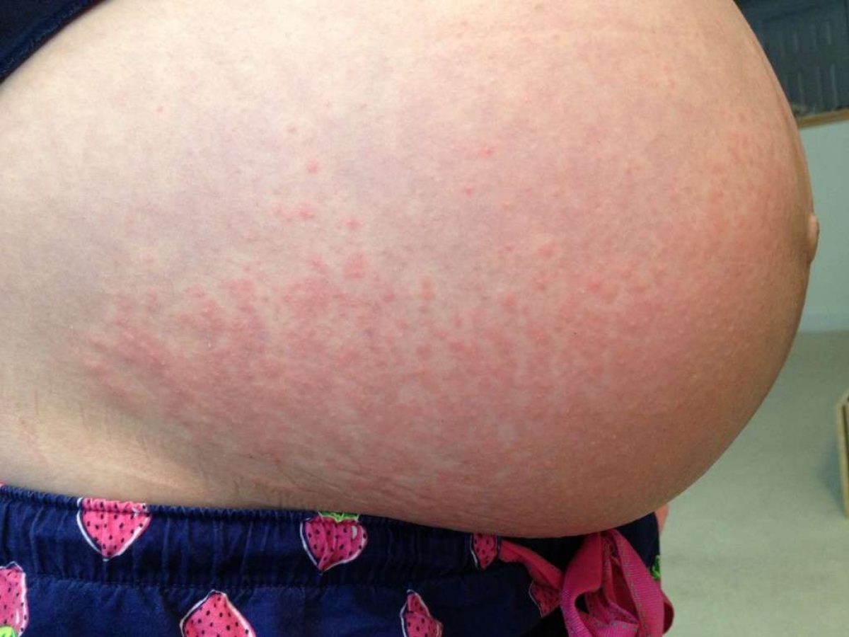 аллергия на груди при беременности фото 1