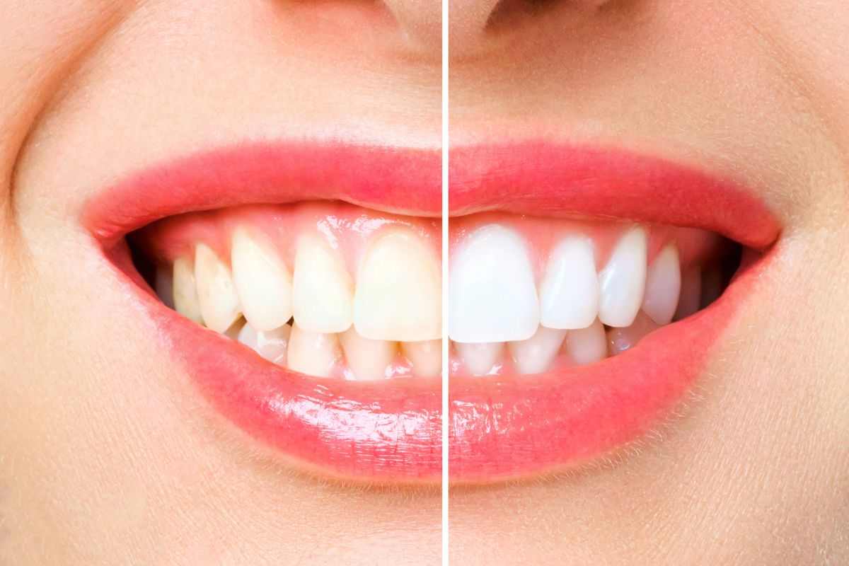 sorriso di una donna con colori diversi di denti